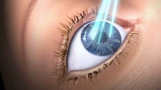 Augenlasern Lasik animierte Erklärvideo