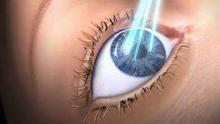 LASIK - animiertes Erklärvideo | MUNICH EYE