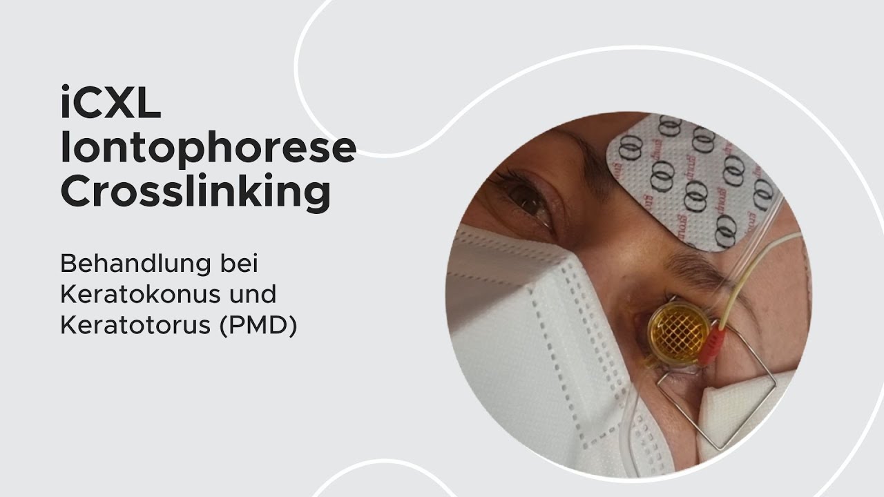 Keratokonus und transepitheliale Crosslinking (EPI-on) Behandlung | OP Erfahrung | MUNICH EYE