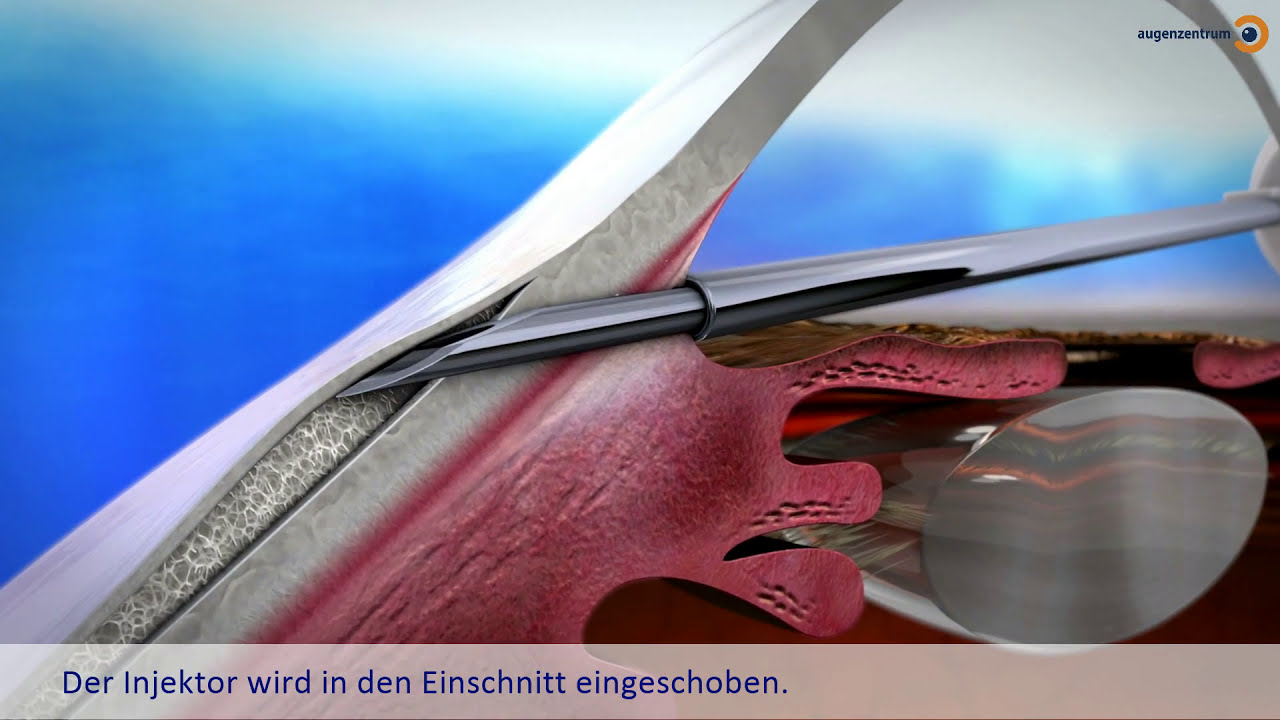 XEN Gel Stent Implantat - Operationsmethode für den Grünen Star (Glaukomtherapie) | MUNICH EYE