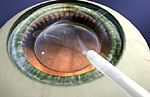EVO+ VISIAN ICL implantierbare Kontaktlinse, Schema wie die Linse ins Auge implantiert wird.