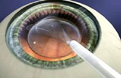 EVO+ VISIAN ICL implantierbare Kontaktlinse, Schema wie die Linse ins Auge implantiert wird.