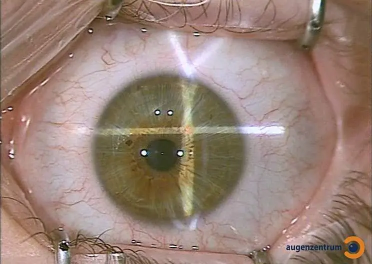 Ein Lidhalter wird vor Lasik Behandlung eingesetzt und verhindert, dass der Patient im falschen Moment das Auge nicht schließt. Der Lidhalter tut nicht weh, der Patient spürt nur ein leichtes Druckgefühl.