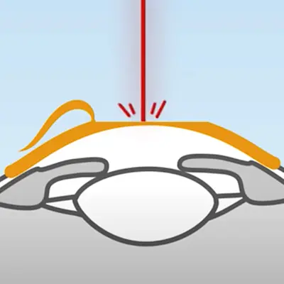 Bei LASIK Augenlasern wird ein kleiner Hornhautschnitt gesetzt, der sogenannte "Flap", der angehoben werden muss, damit der Laser in das Gewebe eindringen kann.