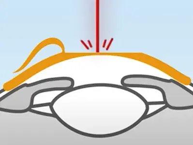 Bei LASIK Augenlasern wird ein kleiner Hornhautschnitt gesetzt, der sogenannte "Flap", der angehoben werden muss, damit der Laser in das Gewebe eindringen kann.