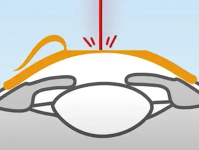 Bei LASIK Augenlasern wird ein kleiner Hornhautschnitt gesetzt, der sogenannte "Flap", der angehoben werden muss, damit der Laser in das Gewebe eindringen kann.