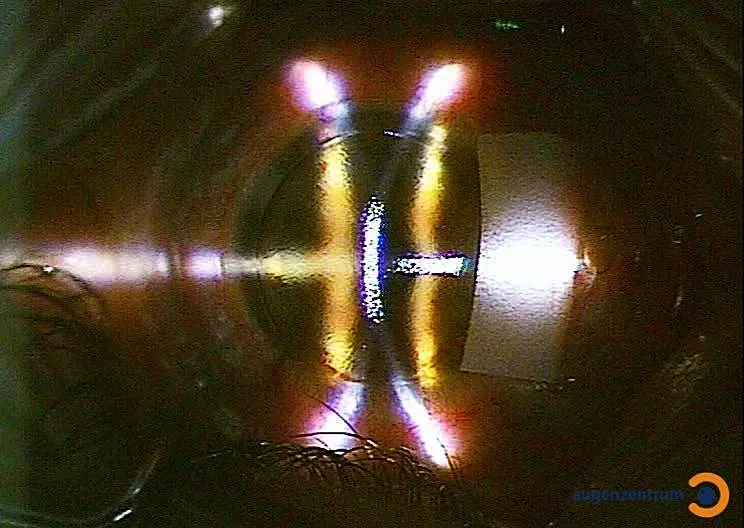 Durch den Augenlaser wird die Hornhaut neu modelliert. 