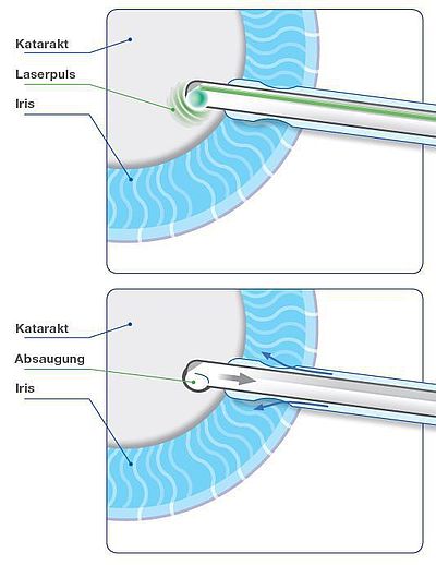 Nanolaser (Nano-Katarakt): Die Energiewelle wird innerhalb der Sonde angegeben.