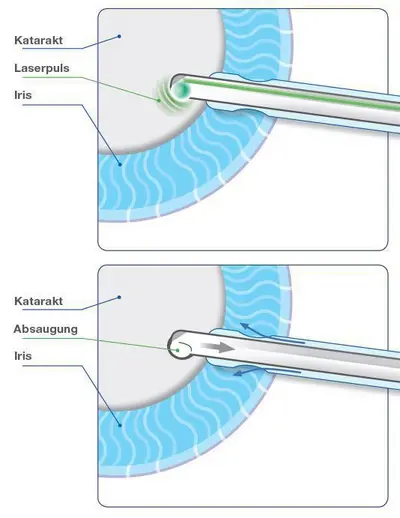 Nanolaser (Nano-Katarakt): Die Energiewelle wird innerhalb der Sonde angegeben.