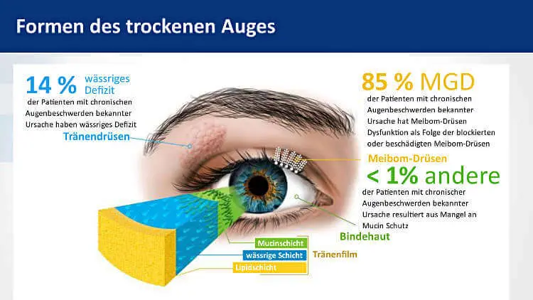 Formen des trockenen Auges