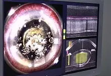 Femtolaser Katarakt Operation Femtolaser Katarakt Operation: FemtoCat - Hornhautschnitte und Vorbereitung der Linsen-OP durch den Femtolaser - In der Mitte Laser induzierte Luftblasen im Auge.