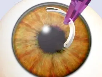 Die ICRS-Implantation ist ein minimal-invasiver ambulanter Eingriff.