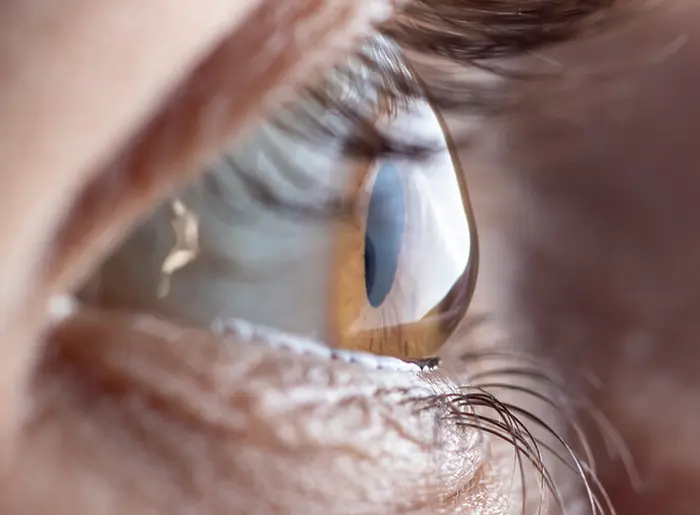 Auge von der Seite mit deutlich sichtbarer, kegelförmigen Vorwölbung der Hornhaut