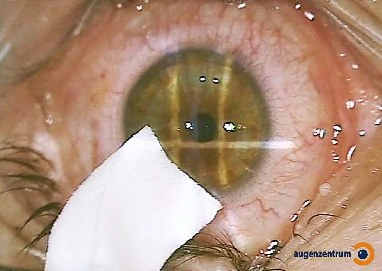 Die Oberfläche der Hornhaut wird nach der Lasik OP geglättet.