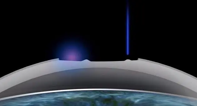 TransPRK Augenlaser Der Excimerlaser übernimmt sowohl die Oberflächebehandlung als auch die Korrektur der Fehlsichtigkeit an der Hornhaut.