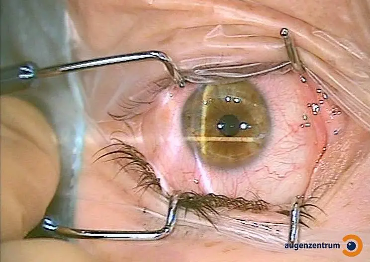 Lidhalter wird vor der LASIK OP eingesetzt.