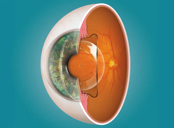 EVO ICL Linse sitzt im Auge, von aussen unsichtbar hinter der Pupille 