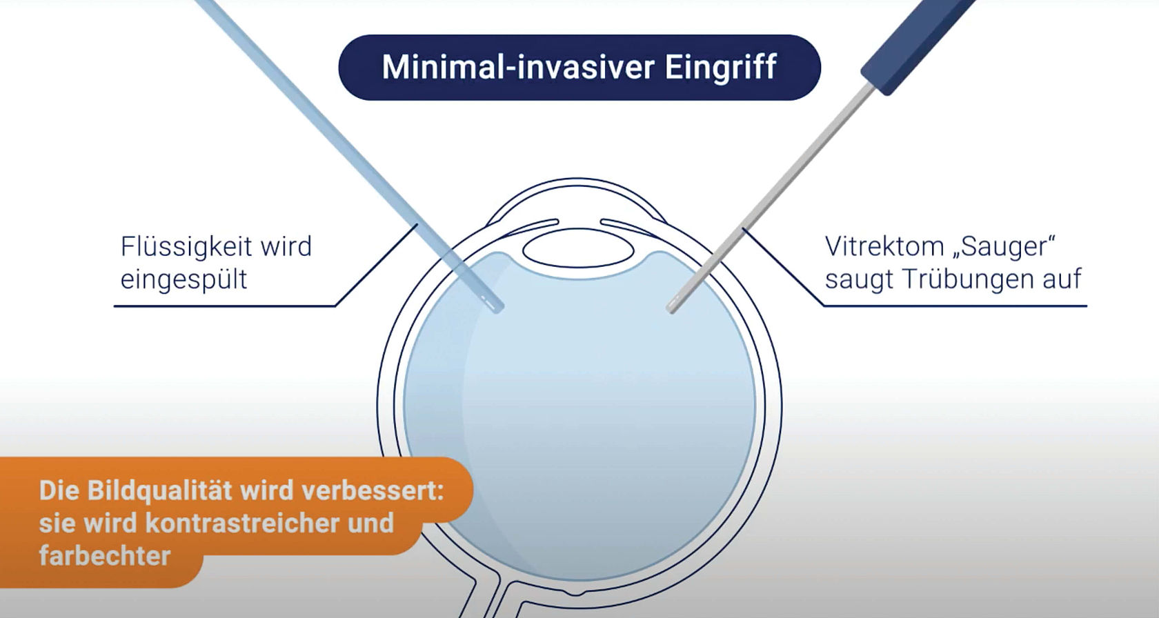 Der Glaskörper wird durch eine gelartige Flüssigkeit ersetzt. Man kann wieder klar sehen