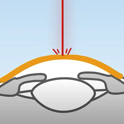 Beim SMART SURF Augenlasern wird kein "Flap" benötigt und somit muss kein Hornhautschnitt gemacht werden.