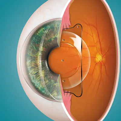 Schematische Zeichnung eines Augapfels, der die Positionierung einer künstlichen Linse hinter der Iris zeigt.