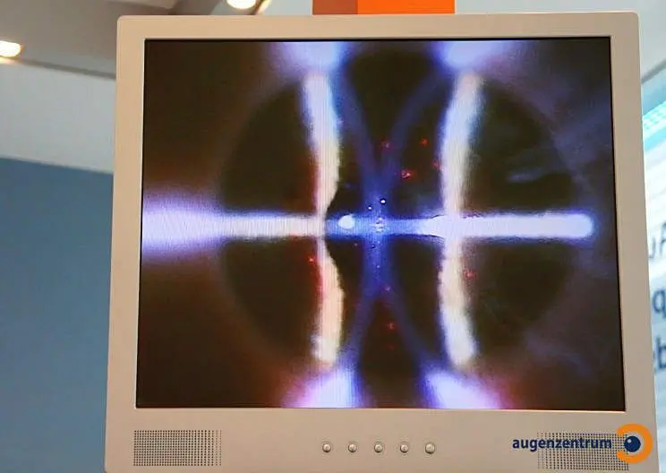 Der Excimer-Laser SCHWIND AMARIS behandelt gleichzeitig sowohl die Deckschicht (Epithel) als auch die tiefere Schicht der Hornhaut. Die Trans-PRK-Laserbehandlung ist schnell, schmerzfrei und wird ohne Berührung des Auges mit chirurgischen Instrumenten du