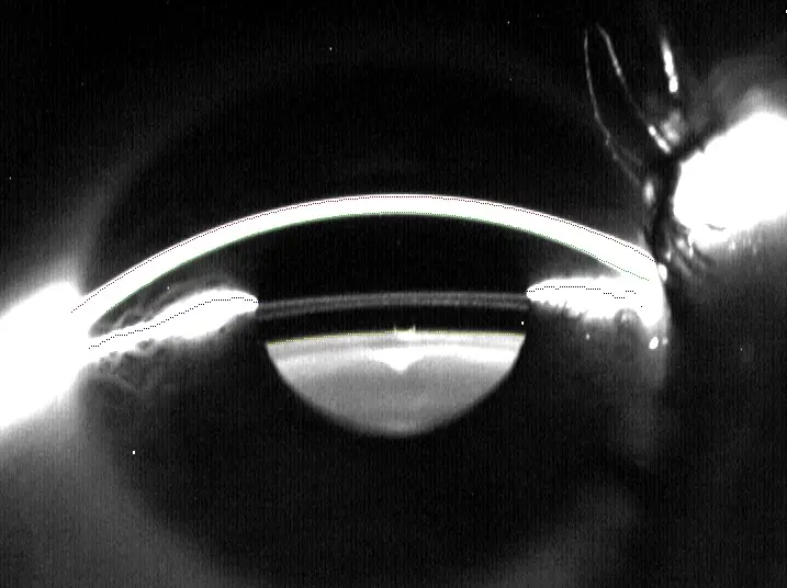 Scheimpflugaufnahme einer implantierten ICL Linse