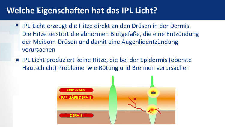 Die Eigenschaften von IPL-Licht