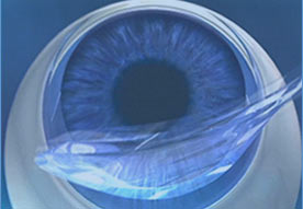 Femto Lasik mit geöffnetem Flap Femto Lasik mit geöffnetem Flap