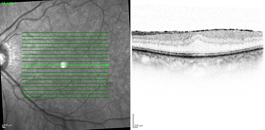 Hochauflösende OCT-Aufnahme der Netzhaut mit einer epiretinalen Gliose