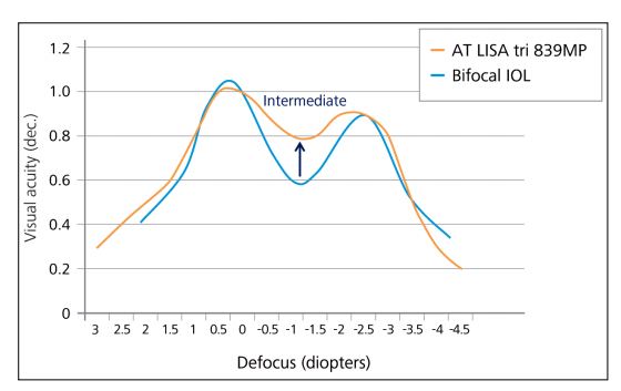Vergleich der bifokalen und trifokalen Linse bei den ZEISS AT.LISA Linsen