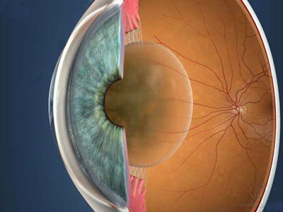 Schema Auge mit trüber Linse. Der Graue Star ist eine Trübung der Augenlinse.