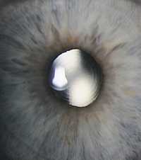 Multifokallinse im Auge