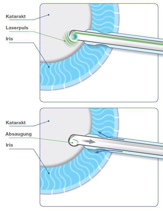 Nanolaser Erklärung Nanolaser (Nano-Katarakt): Die Energiewelle wird innerhalb der Sonde angegeben.
