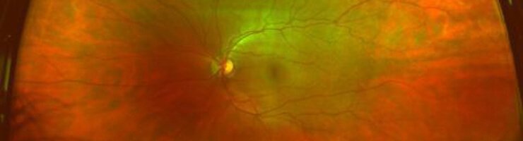 Bild einer Netzhaut - Behandlung von Makuladegeneration im Augenzentrum in München