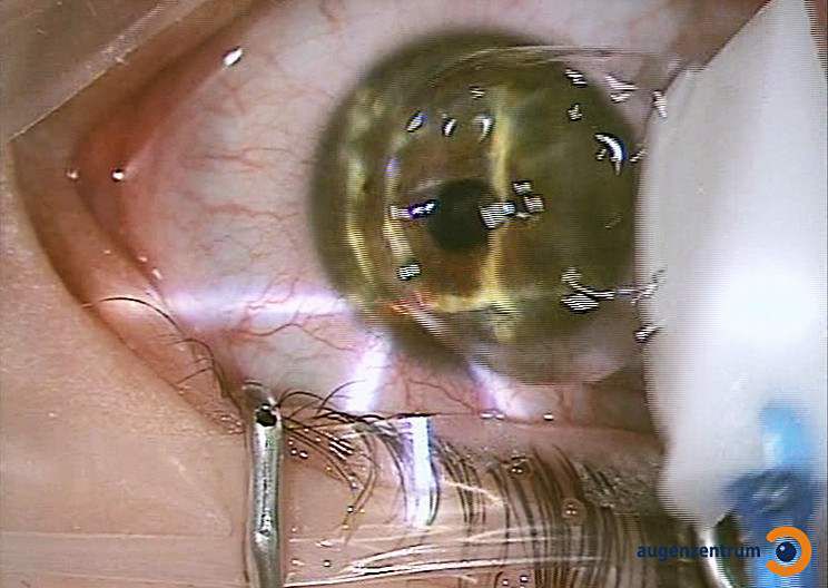 Zum Schluss der Behandlung wird die Hornhaut mit einer Verbandskontaktlinse abgedeckt, die ein paar Tage auf dem Auge bleibt bis sich die Deckschicht der Hornhaut regeneriert hat.